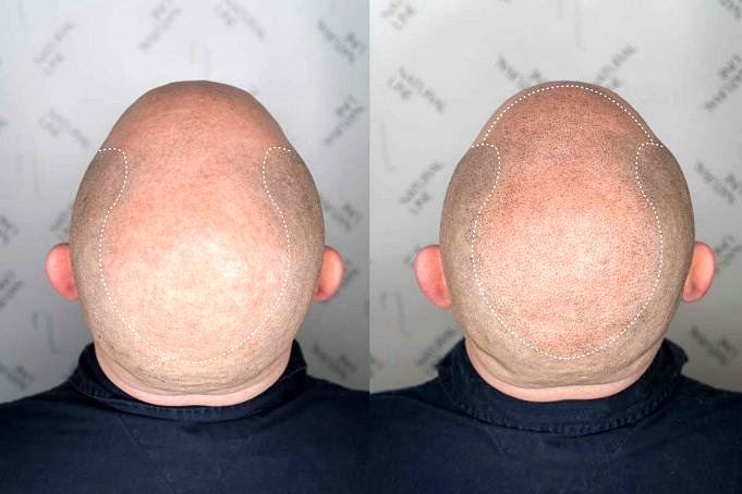 Kopfhaut-Tattoos. Kann Mikropigmentierung Haarausfall Kaschieren?