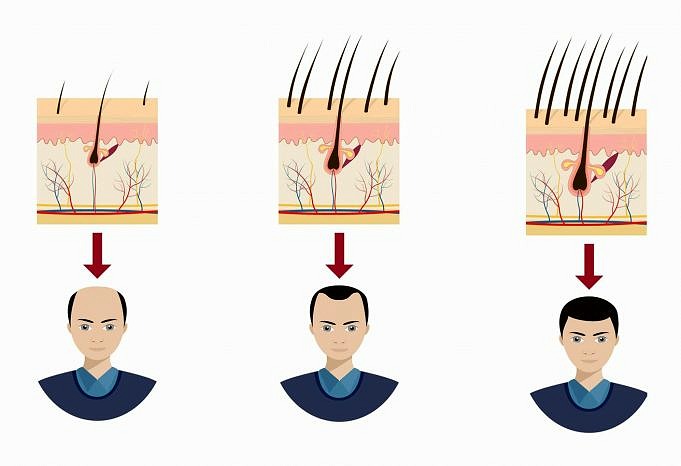 Minoxidil Rogaine Und Wie Man Haarausfall Stoppt