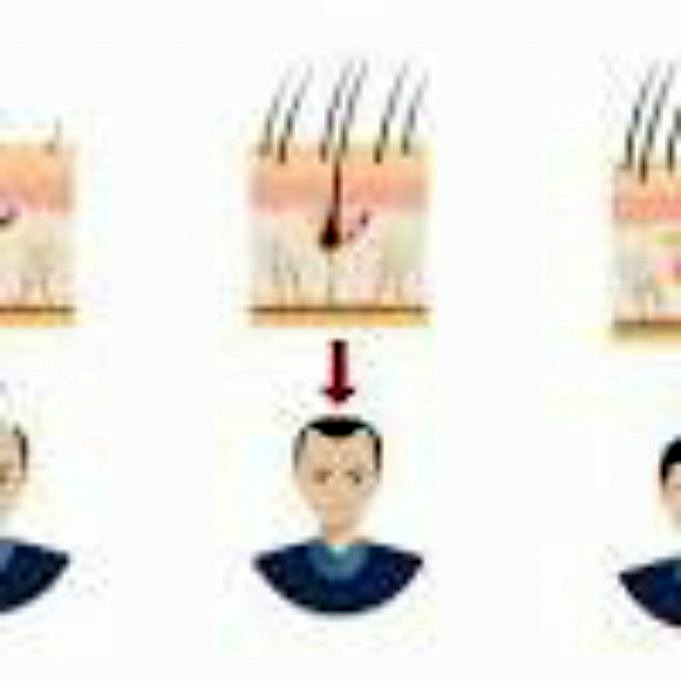 Wie Wirkt Minoxidil Bei Der Behandlung Von Haarausfall Bei Männern?